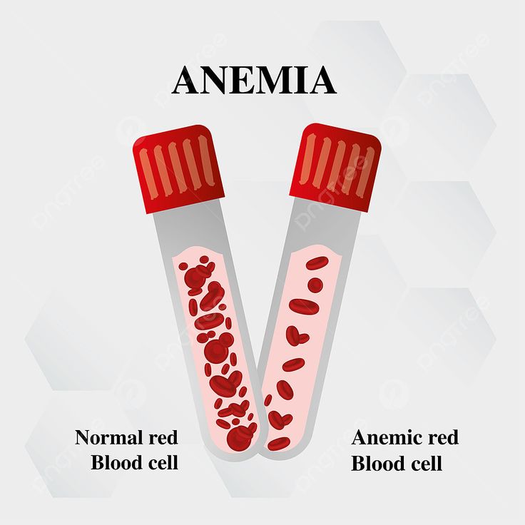 Anemia