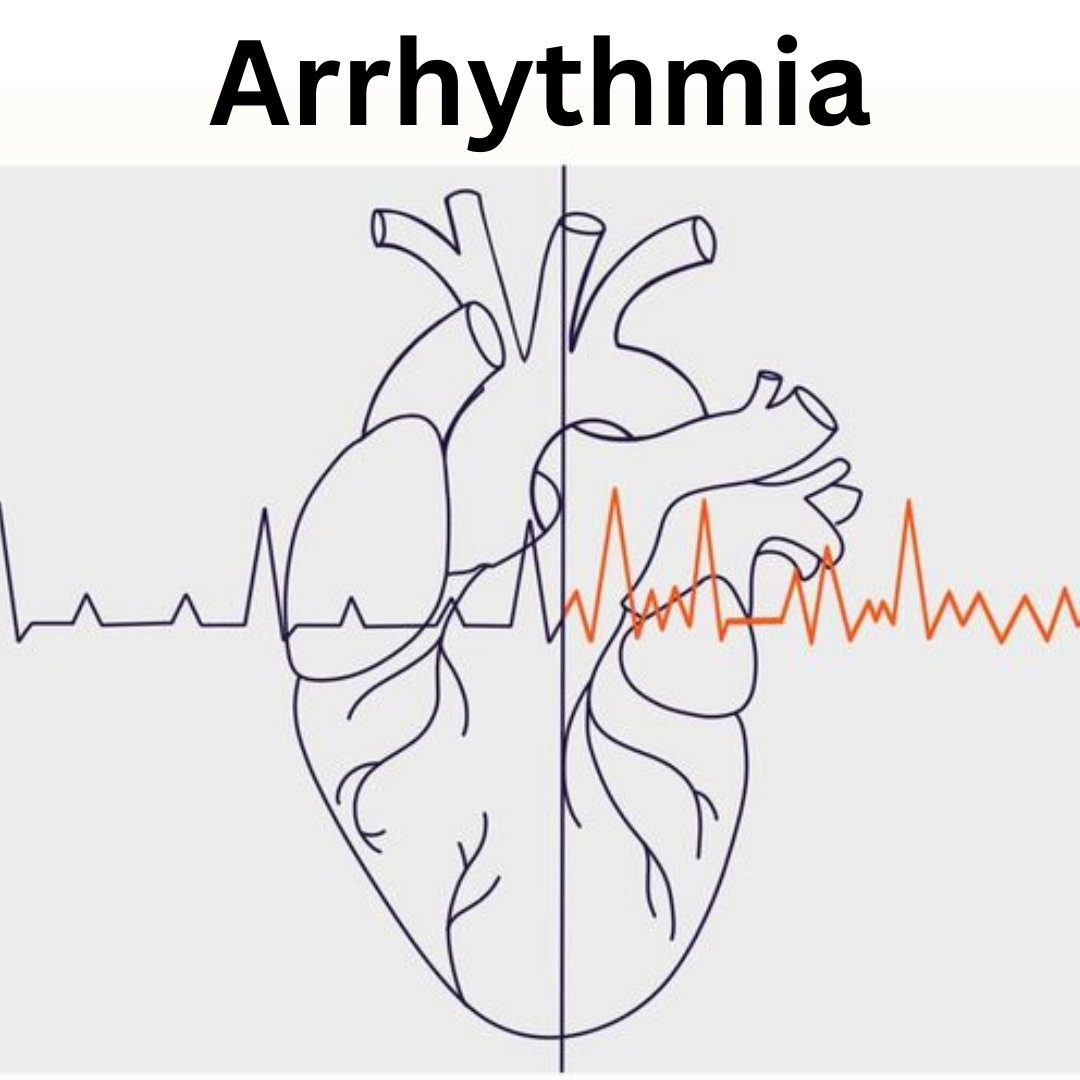 Arrhythmia