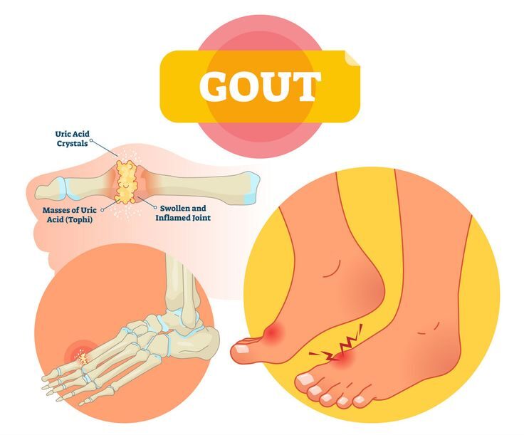 Gout Disease