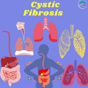 Cystic Fibrosis