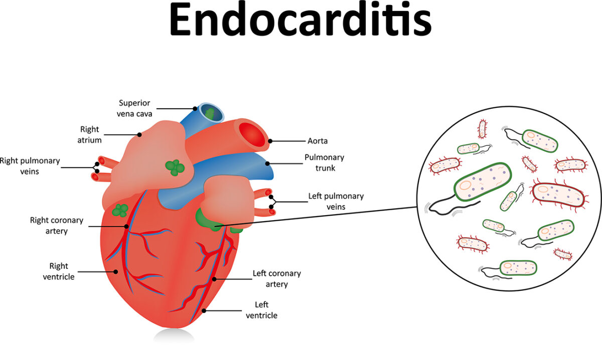 Endocarditis Disease