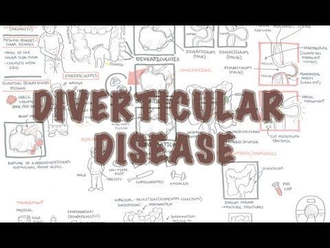 Diverticulitis Disease
