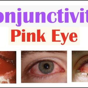 Conjunctivitis (Pink Eye) 