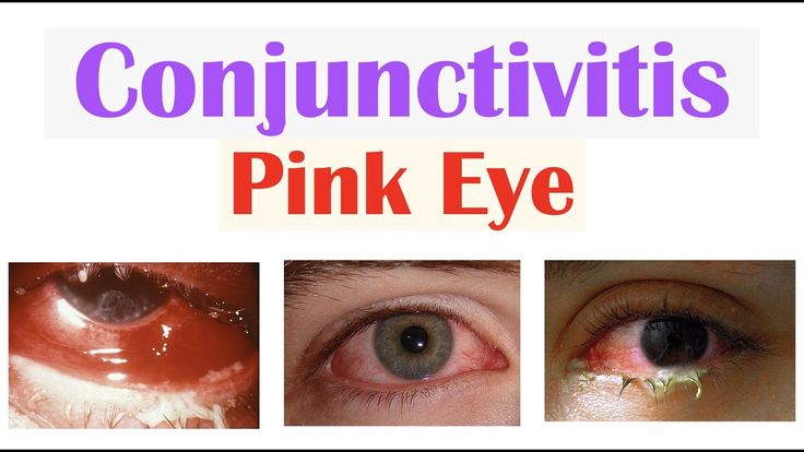 Conjunctivitis (Pink Eye) 