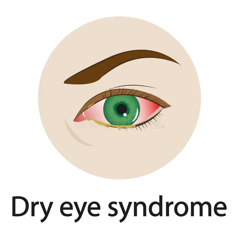 Dry Eye Syndrome