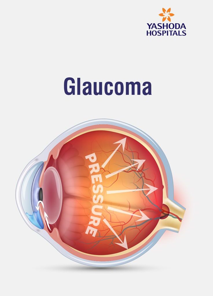 Glaucoma Disease