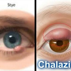 Chalazion Disease