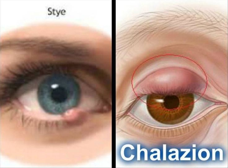 Chalazion Disease