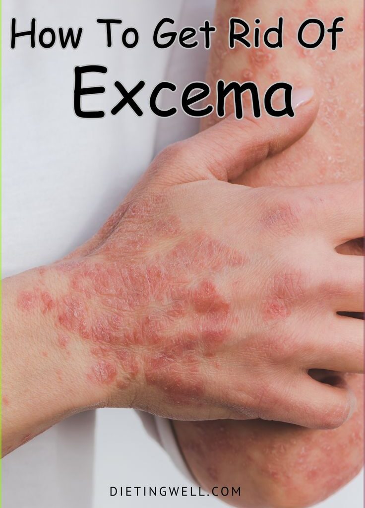 Eczema Disease