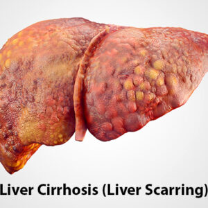 Cirrhosis Disease